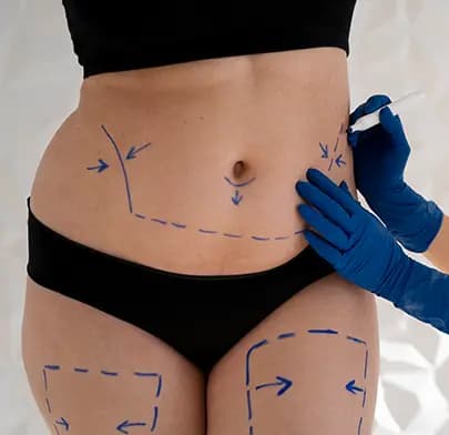 Liposuction