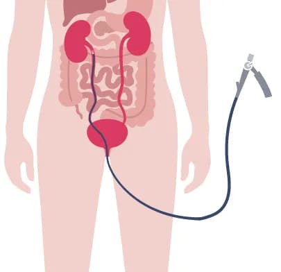 Medical illustration of urinary system with catheter, depicting procedure related to Ureteroscopy (URS) in India.
