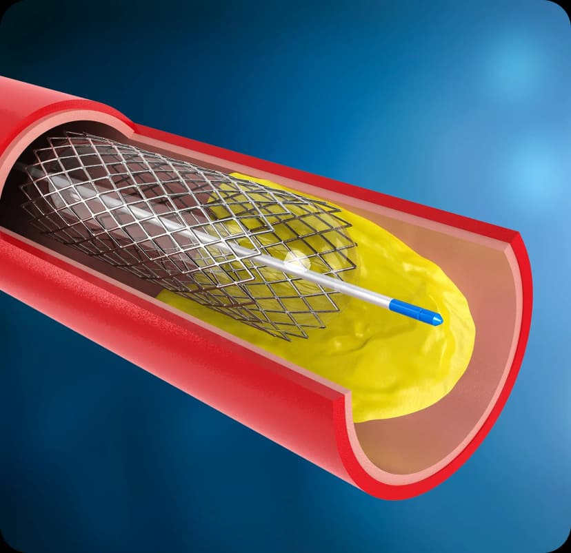 Digital anatomical illustration highlighting the heart and blood vessels to represent Aortic Aneurysm Surgery and vascular repair.