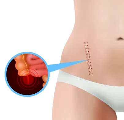 Appendectomy