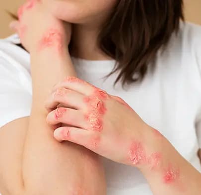dermatomyositis