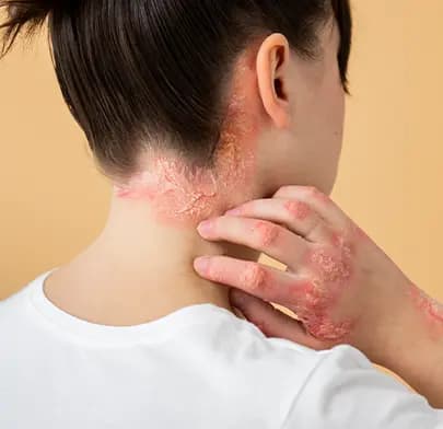 juvenile dermatomyositis