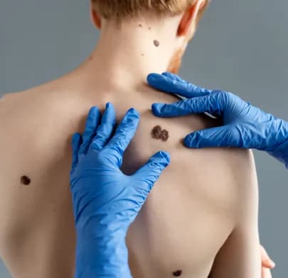 Person’s back being examined for large moles, highlighting skin checks for potential Melanoma.