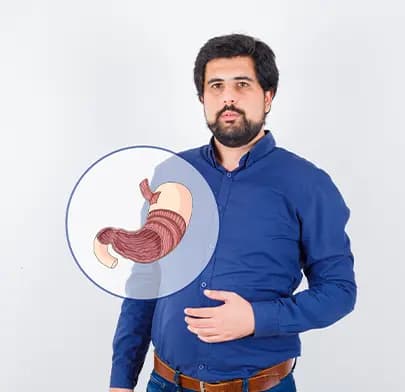 Sleeve gastrectomy