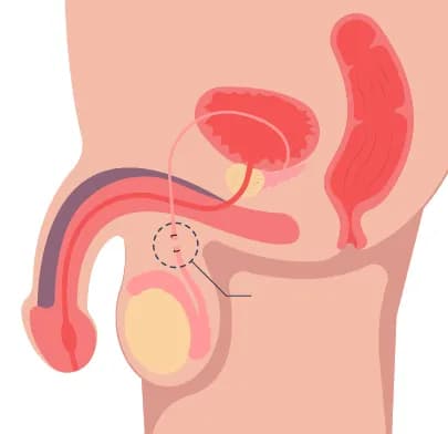 Medical illustration of male reproductive system highlighting vas deferens, representing Vasectomy procedure in India.