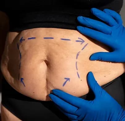 Whipple surgery